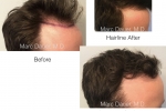 hair transplant photos