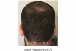donor zone post hair transplant