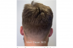 Donor zone  after FUE hair transplant