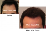 Hair Transplants Pictures