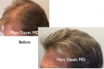 Before and After Hair Restoration Photos