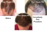 Before and After Hair RestorationPhotos