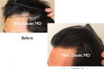 FUT Hair Transplant To Hairline