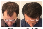 Before and After Hair Transplant Photos