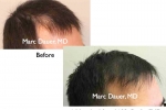 Before and After FUE Hair Transplant Photos