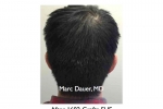 Before and After FUE Hair Transplant Photos