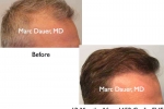 FUE Hair Transplant Photos
