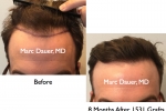 before and after hair transplant photos