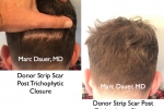 donor area after FUT hair transplant