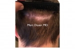 hair transplant strip scar photo