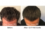 Before and After Hair Transplant Photos