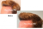 Before and After Norwood 4 Hair Transplant