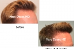 Before and After Norwood 4 Hair Transplant