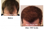 Hair Transplants Images