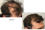 hair transplant photos