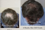 Hair Transplant & Restoration