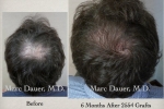 Hair Transplantation Results