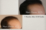 Best Hair Loss Restoration & Transplant