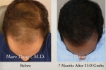 Hair Restoration Surgery