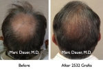 Hair Transplant Hair Transplant before and after Pictures