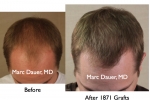 Photos before and after hair transplant results