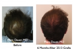 Marc Dauer,MD Hair Restoration