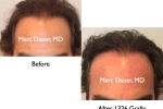 hair transplant before and after photos in norwood 5 patient