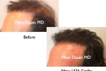 hair transplant before and after photos in norwood 5 patient