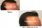 before and after FUE hair transplant photos