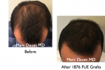 before and after FUE hair transplant photos