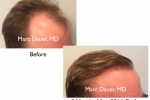 before and a after hair transplant photos
