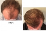 before and a after hair transplant photos