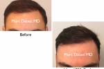 before and after hair transplant photos