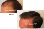 hair transplant before and after photos