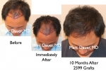 Hair Restoration Photo Gallery