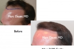 Hair restoration information