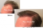 Before and after hair transplant photos