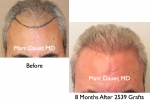 Hair Restoration & Hair Transplant