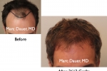 Before and After Photos for Hair Replacement