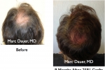 Hair Transplant & Hair Restoration Surgery