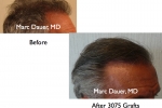 Hair Transplant & Restoration 