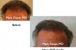Hair Transplant (Restoration) Pictures