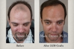 Hair Transplant Hair Transplant before and after Pictures