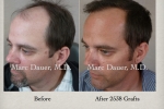 Hair Restoration Hair Loss Treatments for Men