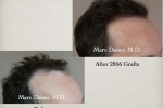 Hair Transplantation Results 