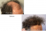 FUE hair transplant photos