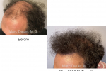 FUE hair transplant photos