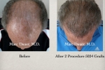 Hair Transplant Before & After Pictures