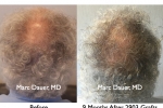 Hair Transplant Photos