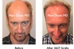 Before and After hair transplant photos
